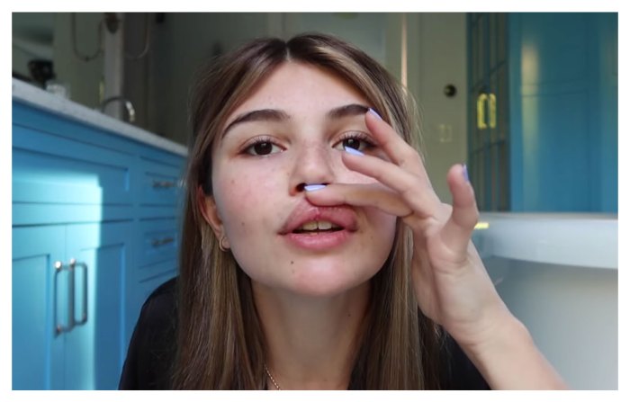 Olivia Jade Shows Off Her Injuries After Fainting Incident