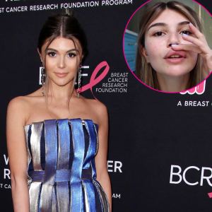Olivia Jade Shows Off Her Injuries After Fainting Incident