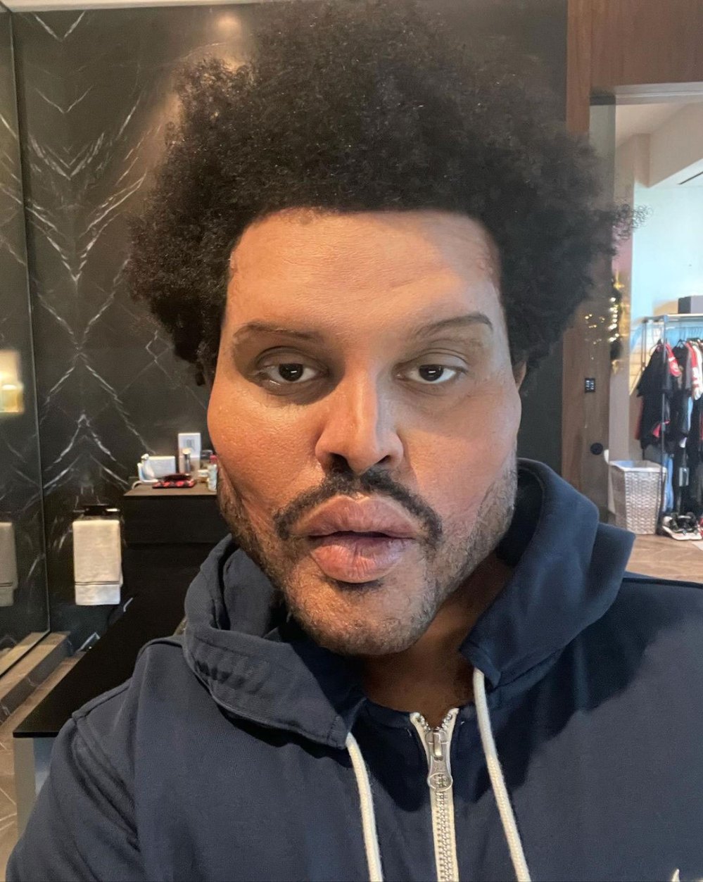 The Weeknd Face Appears Normal After Plastic Surgery Speculation