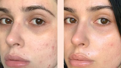 Acne Treatment Serum