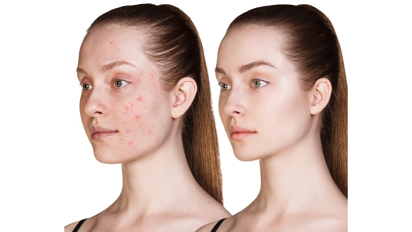 Before-After-Skincare-Stock-Photo