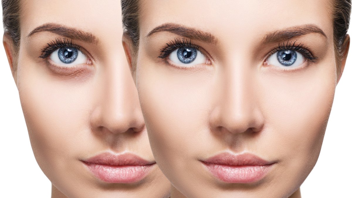 Dark-Circles-Before-After-Stock-Photo