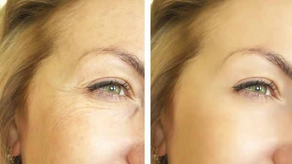 Wrinkle-Before-After-Stock-Photo