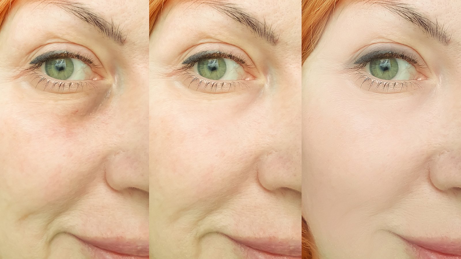 before-after-wrinkles-aging