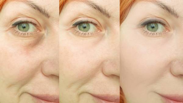 before-after-wrinkles-aging