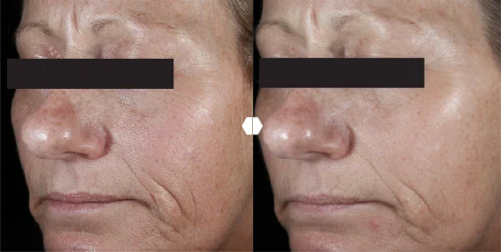 c-e-ferulic-before-after