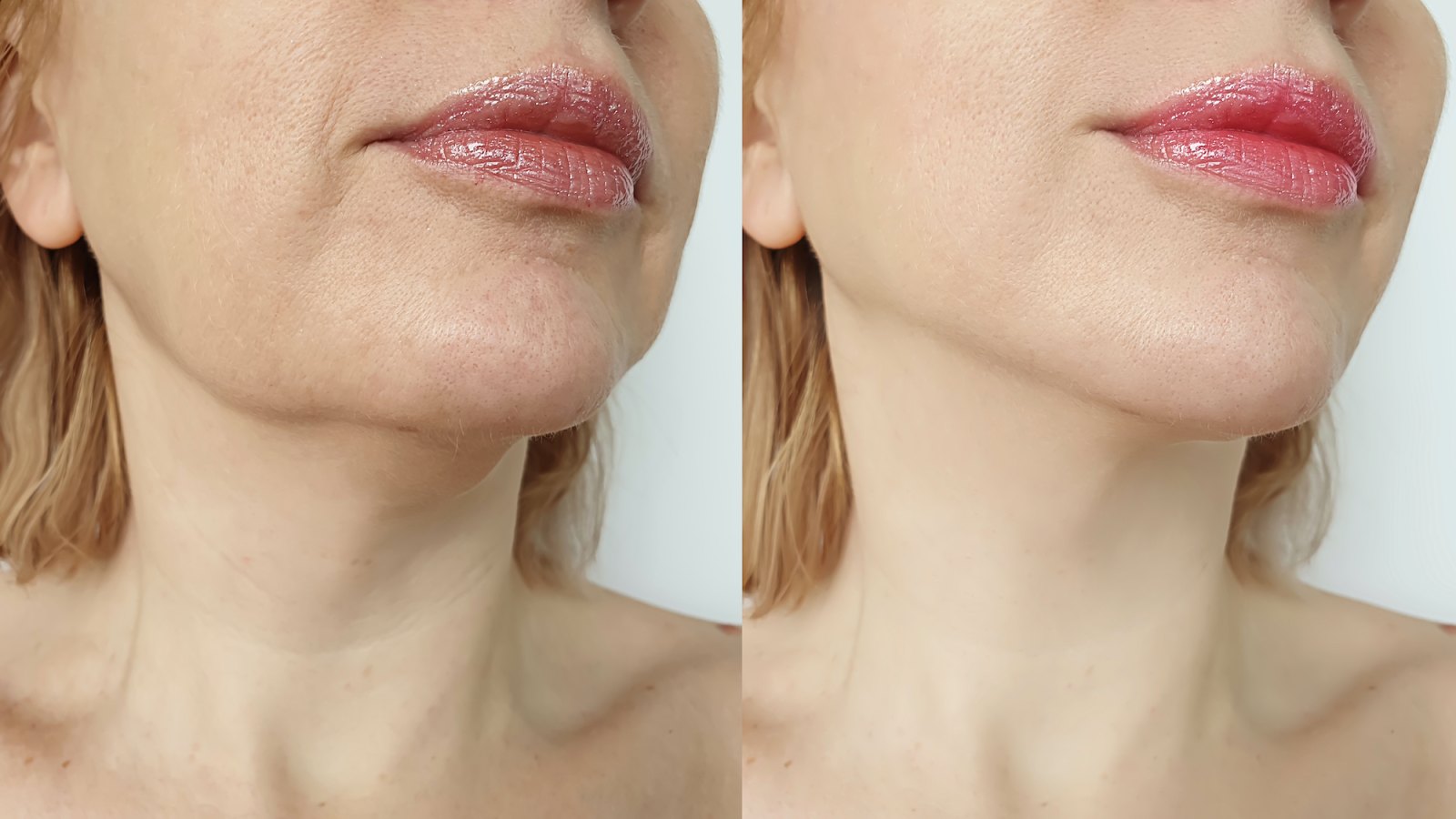 Before-After-Neck-Treatment-Stock-Photo