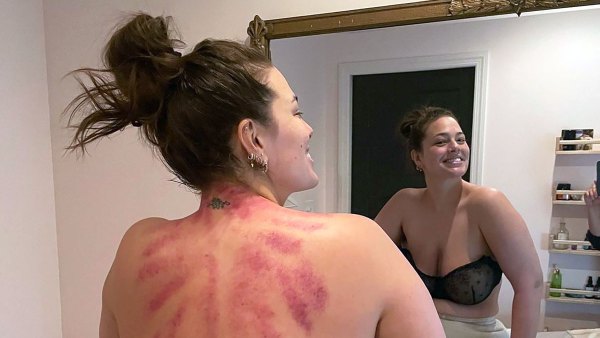 Everything We Know About Ashley Graham’s Body-Scarring Beauty Treatment