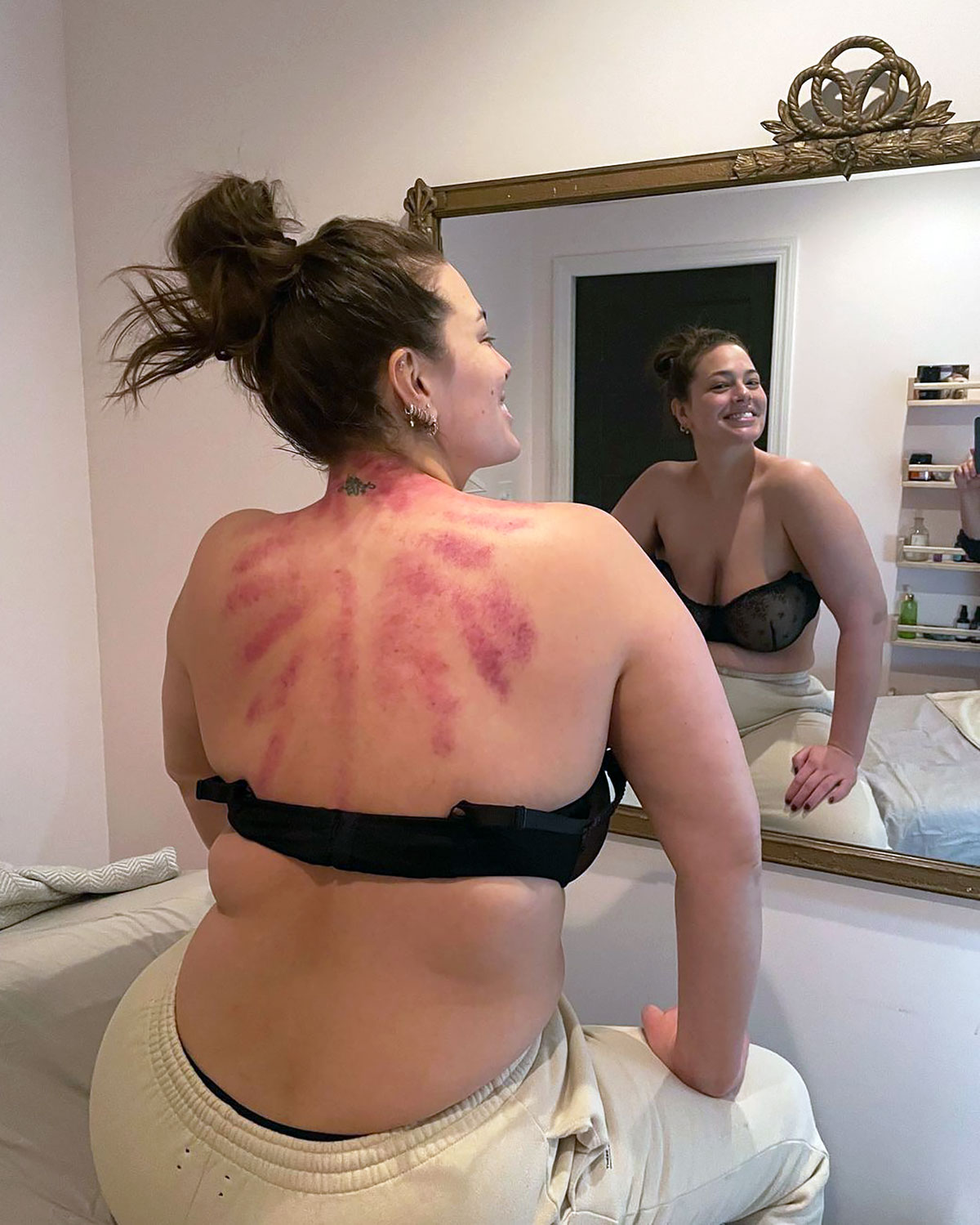 Ashley Graham Shows Off Bruises From Gua Sha Treatment