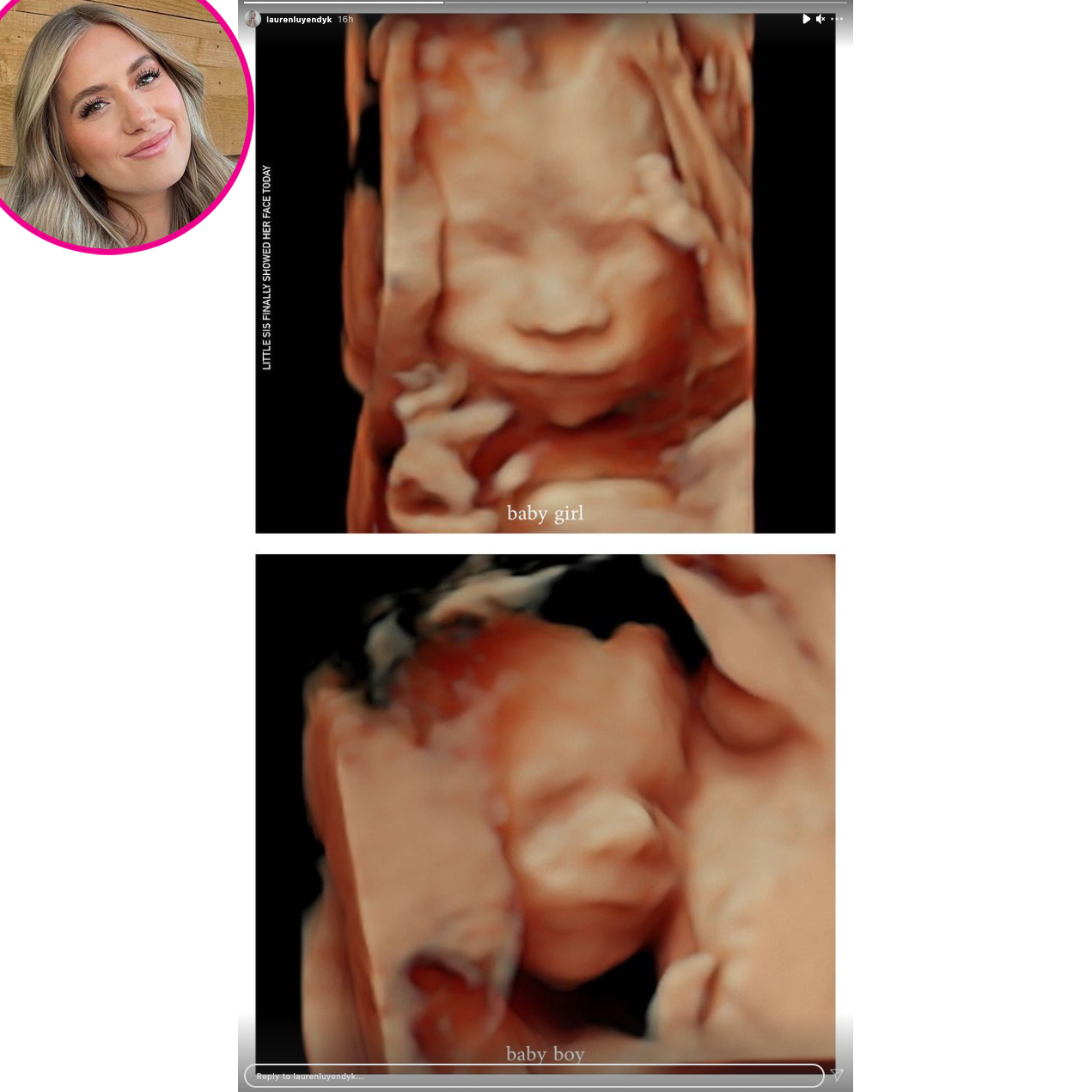 Lauren Burnham ultrasound