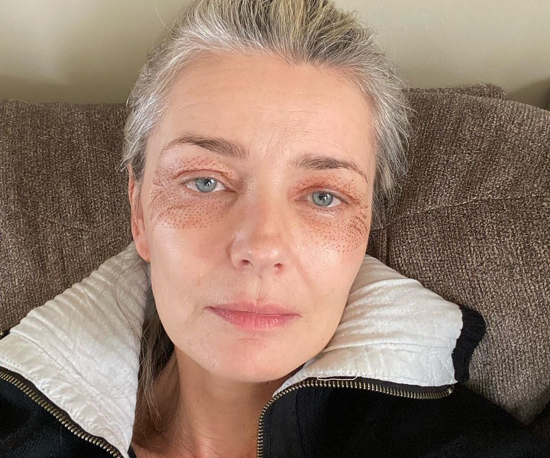 Paulina Porizkova, 55, Shows Off Puncture Marks from Anti-Aging Treatment: “I’m Vain and Want to Be Pretty’