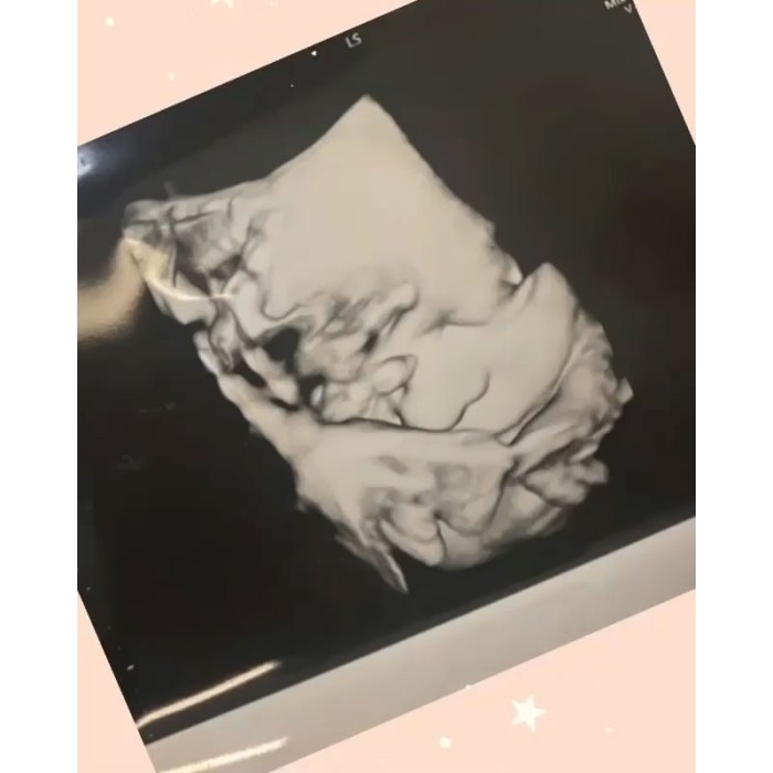 Pregnant Krystal Nielson Describes Umbilical Cord Cyst Possible Birth Complications