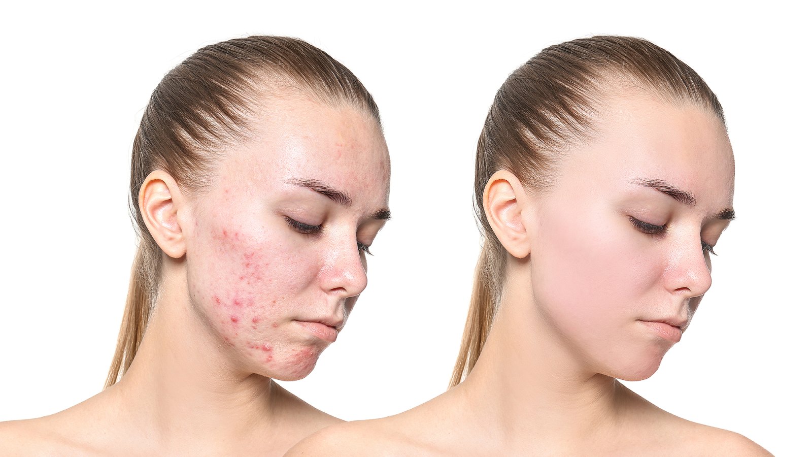 before-after-acne