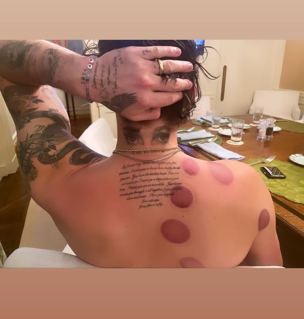 Everything We Know About Brooklyn Beckham&rsquo;s Body Bruising Treatment