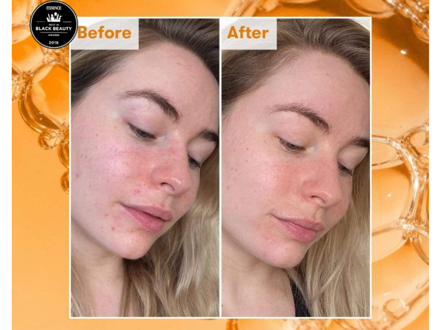 Ren Skincare Before And After