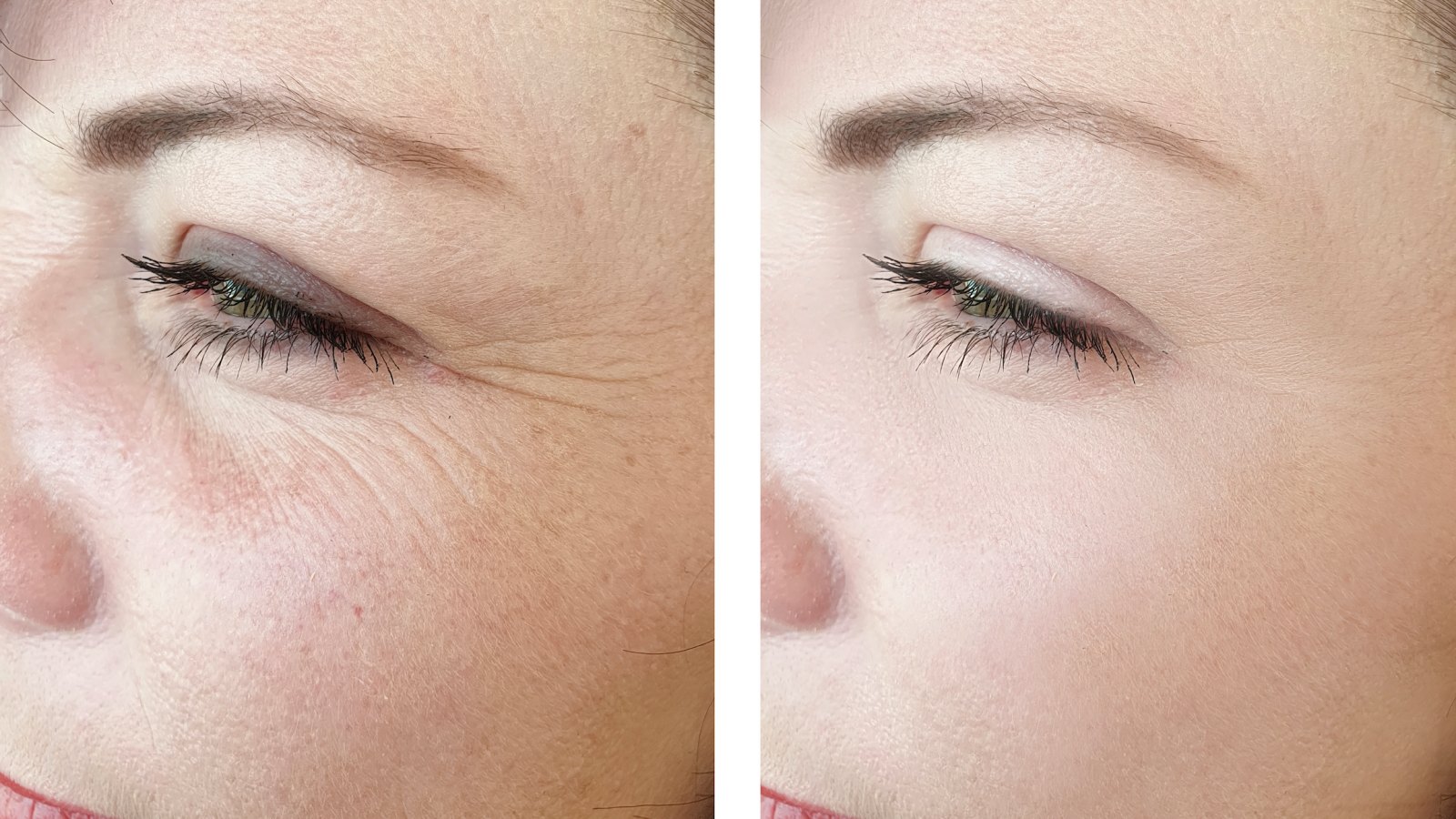 Woman-Before-After-Wrinkles
