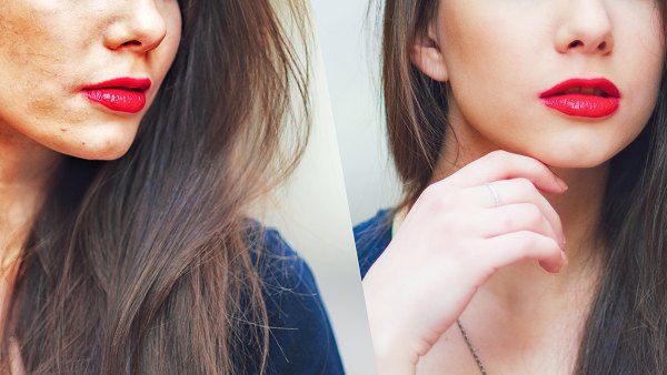 hyperpigmentation-before-after