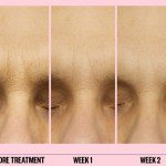 peace-out-microneedling-patches-wrinkle-before-after