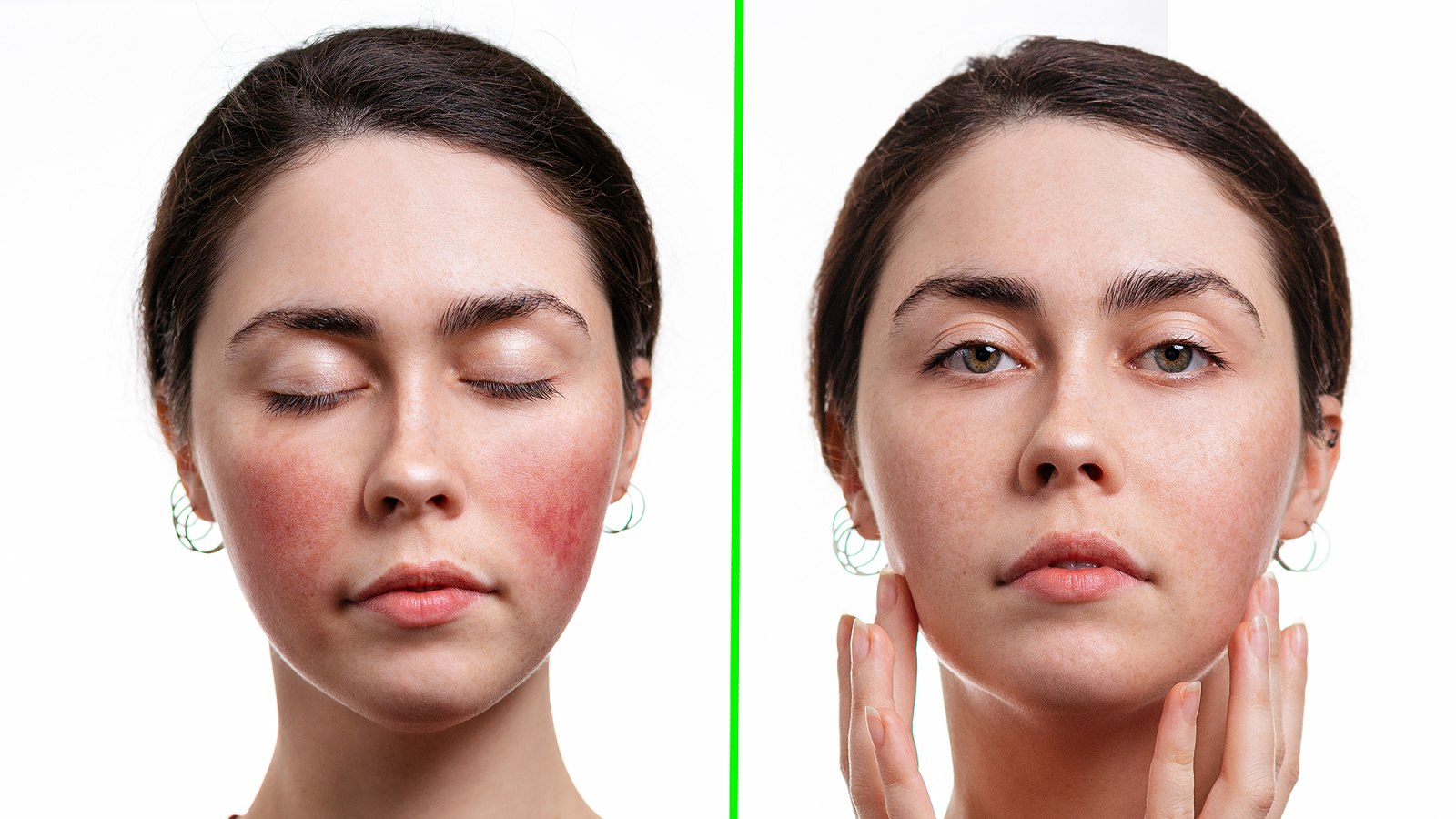 red-rosacea-before-after-skincare