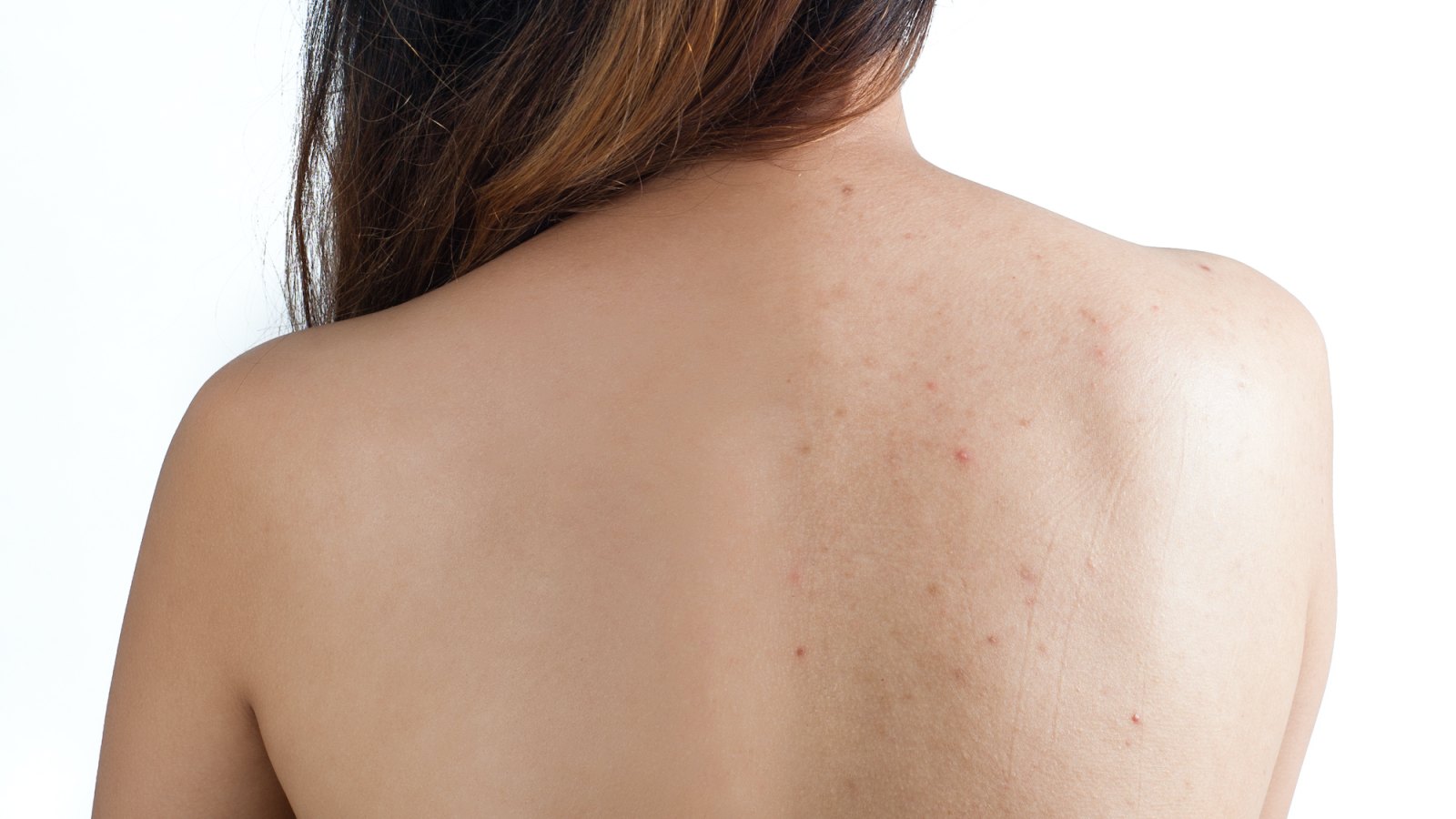Before-After-Body-Acne-Stock-Photo
