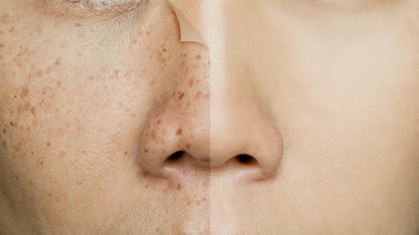 Before-After-Dark-Spots-Stock-Photo