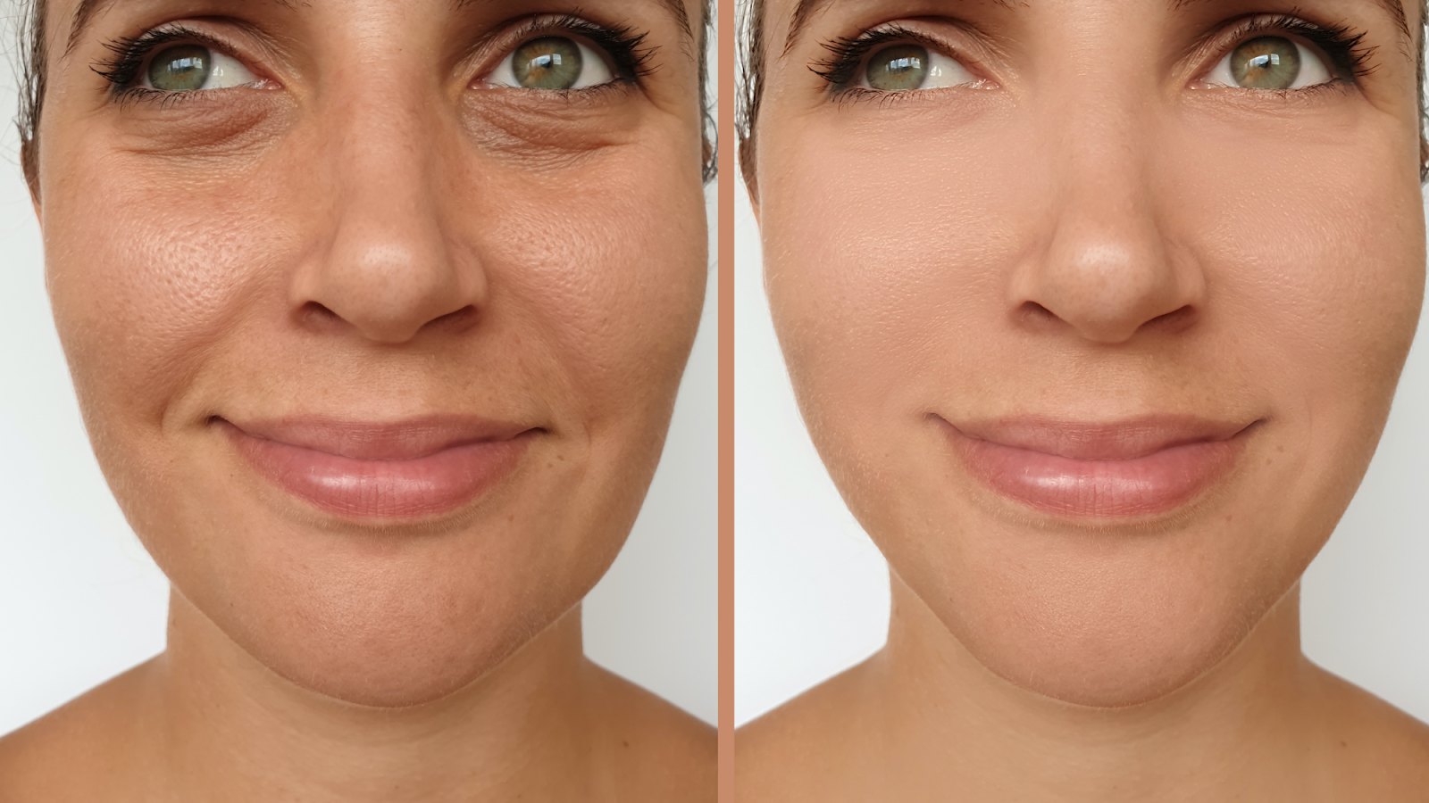 Before-After-Wrinkle-Treatment-Stock-Photo