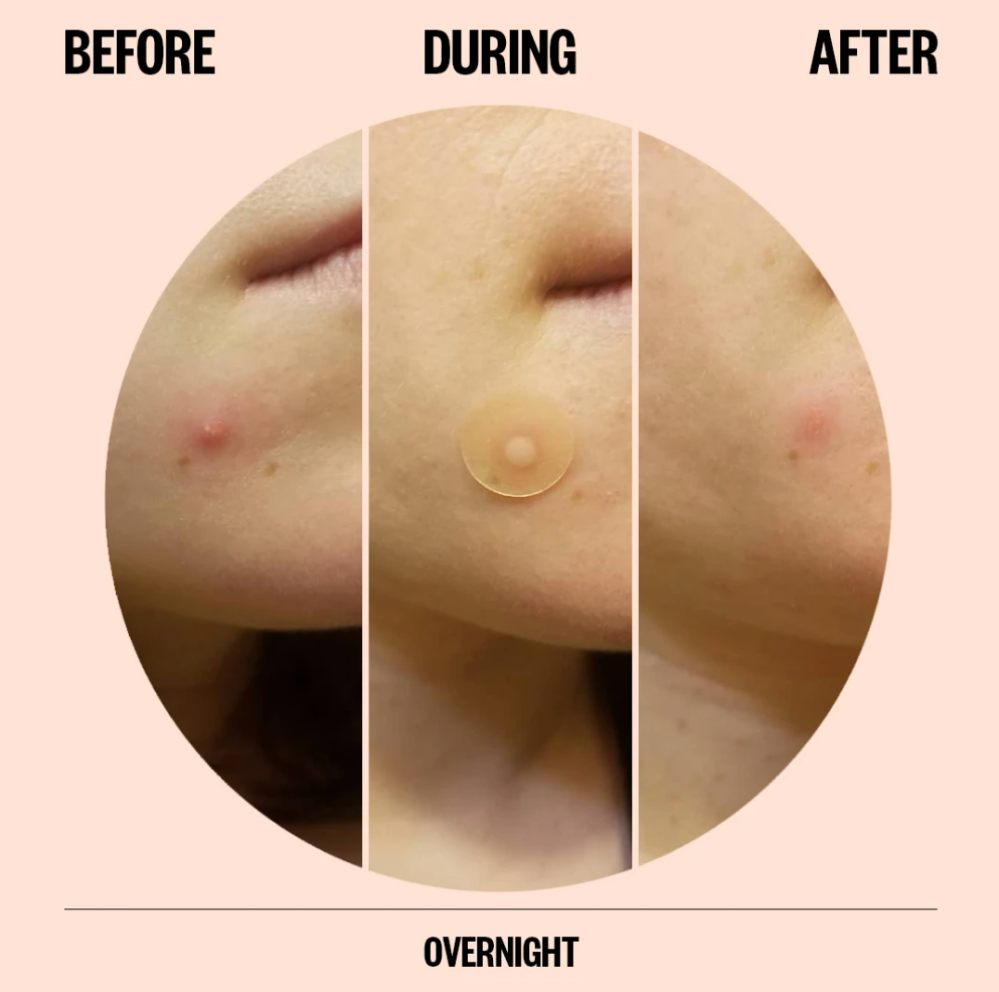 Peace Out Acne Dots
