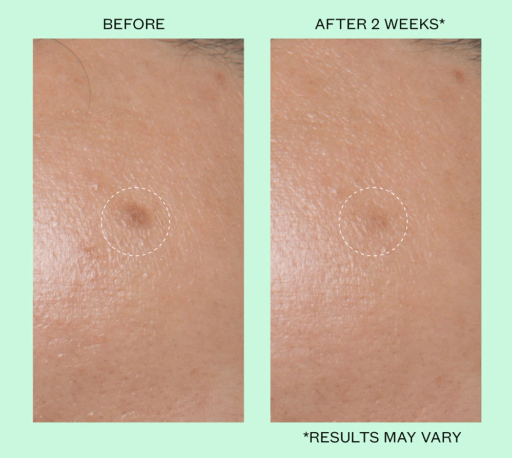 Peace Out Dark Spots Dissolving Microneedling Brightening Dots
