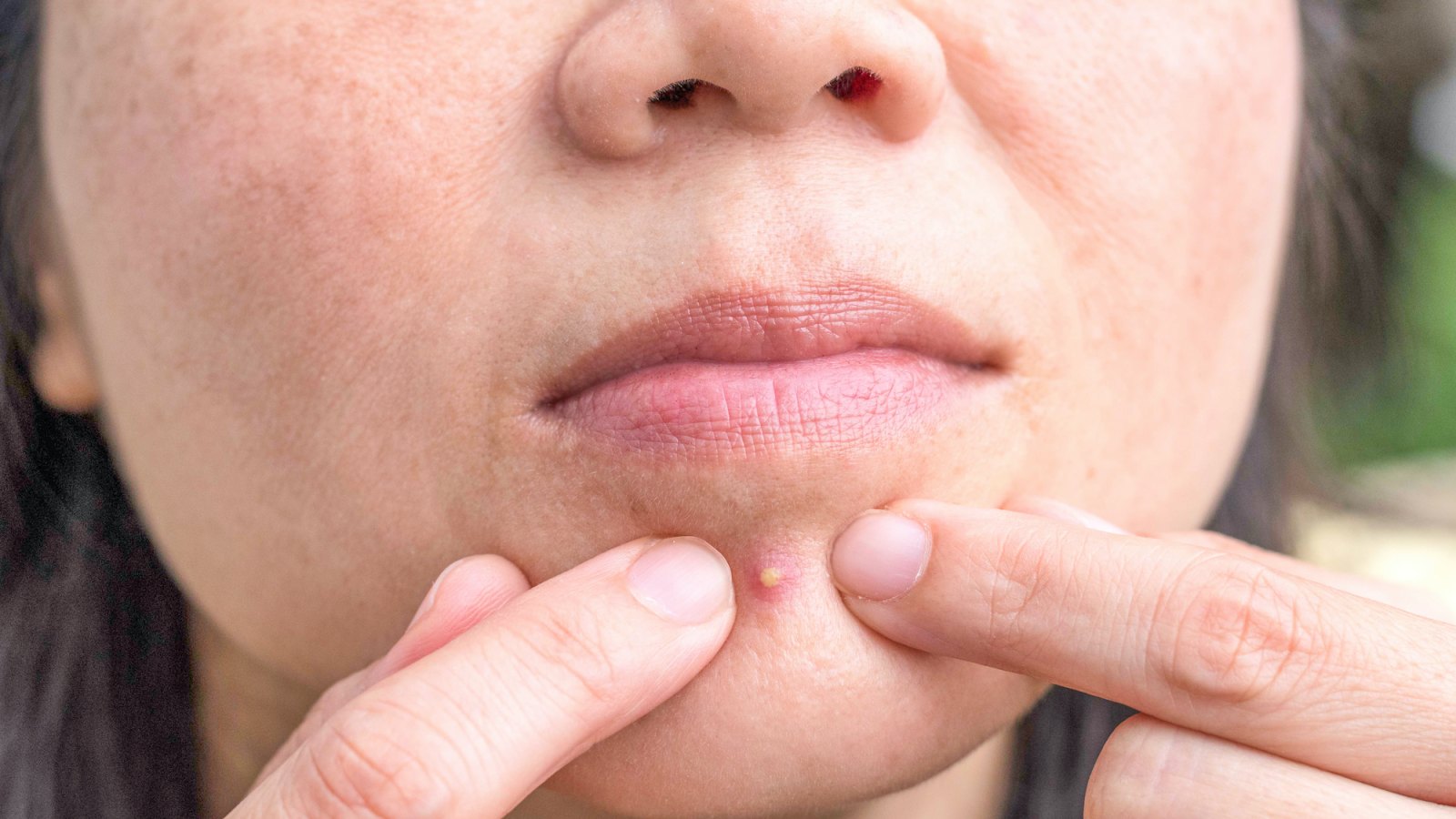 Pimple-Popping-Stock-Photo