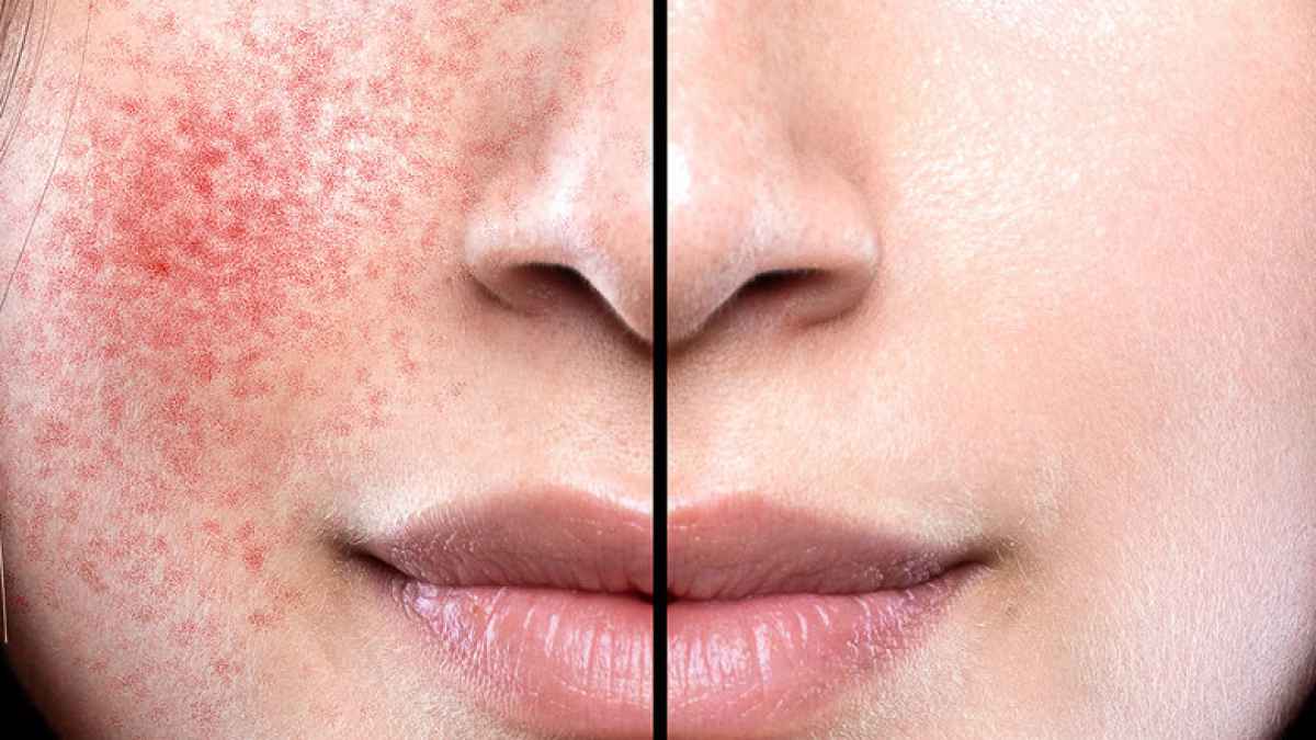 Avene-Narrativ-CPC-88-noticed-visible-reduction-skin-flushing-Soothing-Concentrate