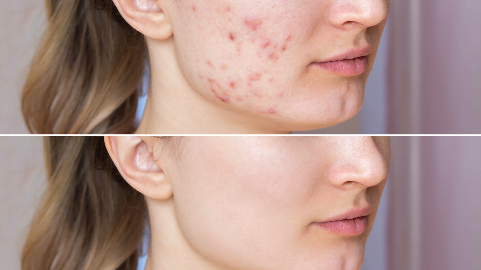 Before-After-Acne-Mask-Stock-Photo