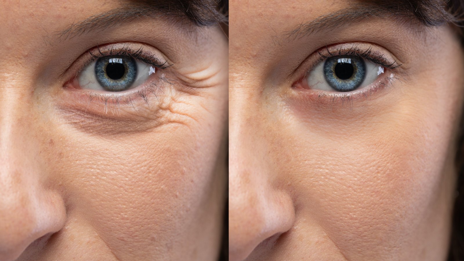 Before-After-Eye-Wrinkle-Stock-Photo