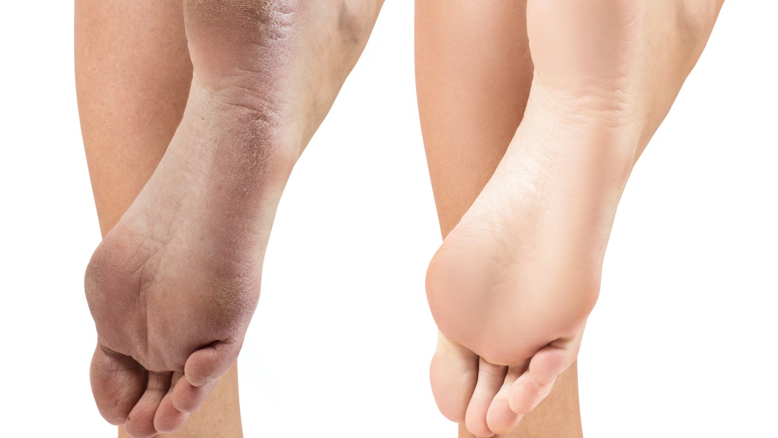 Before-After-Foot-Treatment-Stock-Photo