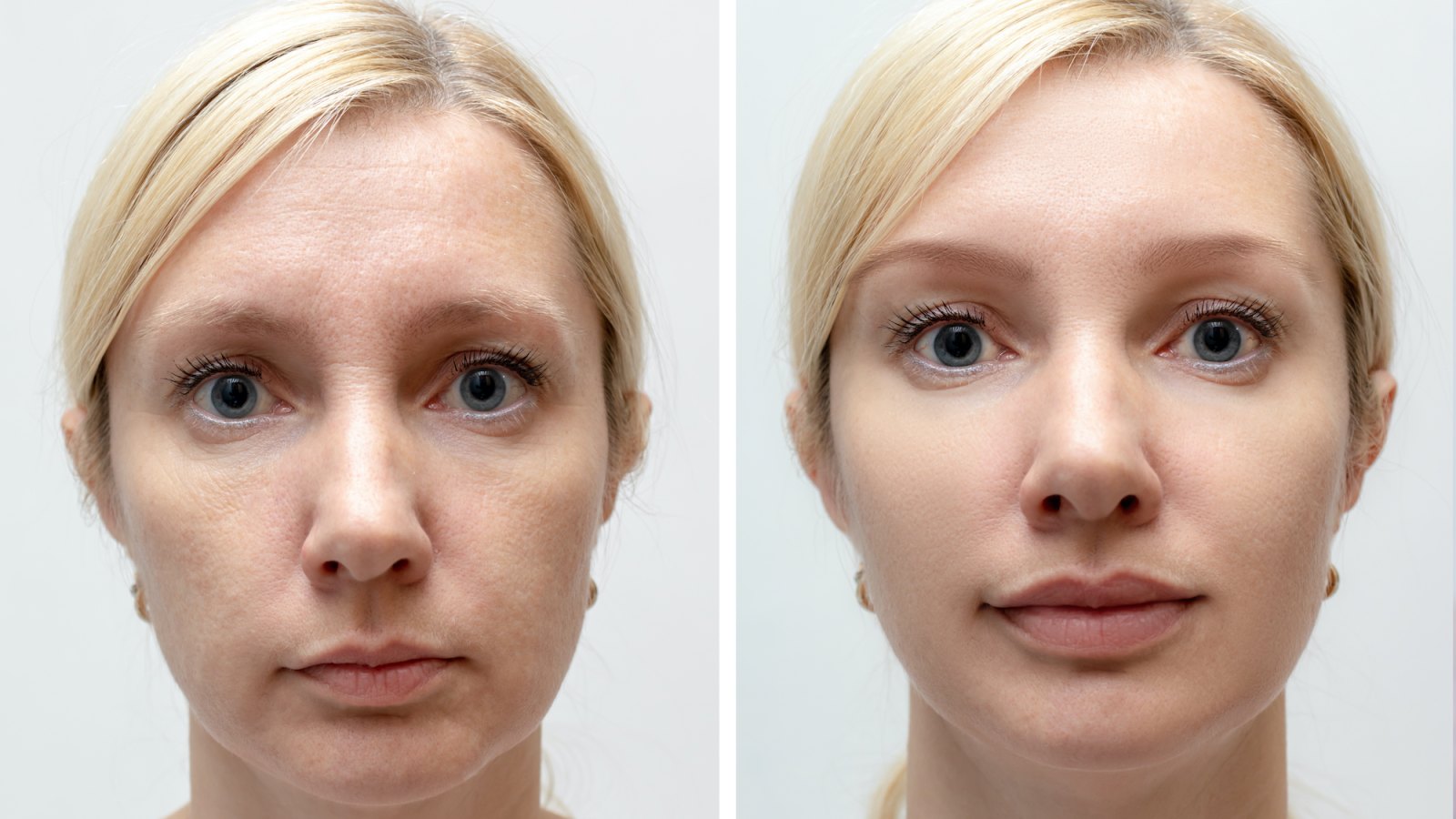 Before-After-Skin-Smoothing-Stock-Photo