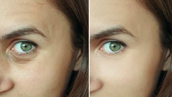 Before-After-Wrinkle-Treatment-Stock-Photo