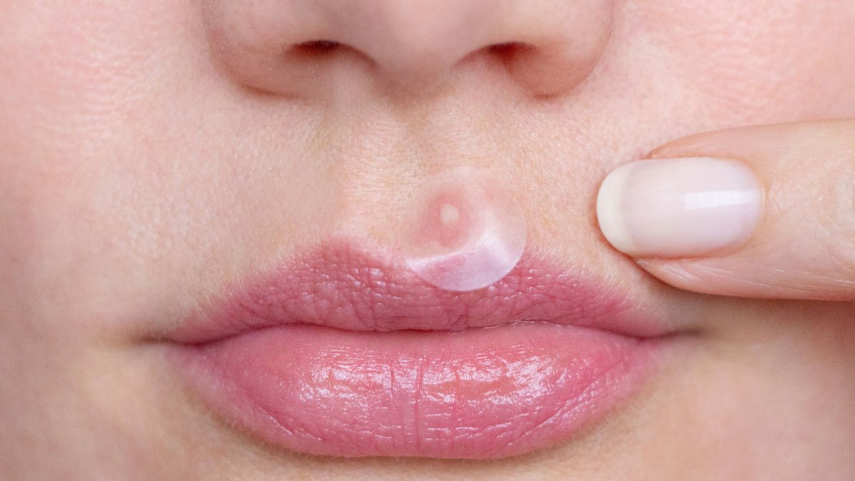 No-1-Best-Selling-Pimple-Patch-gets-rid-zits-little-6-hours-001