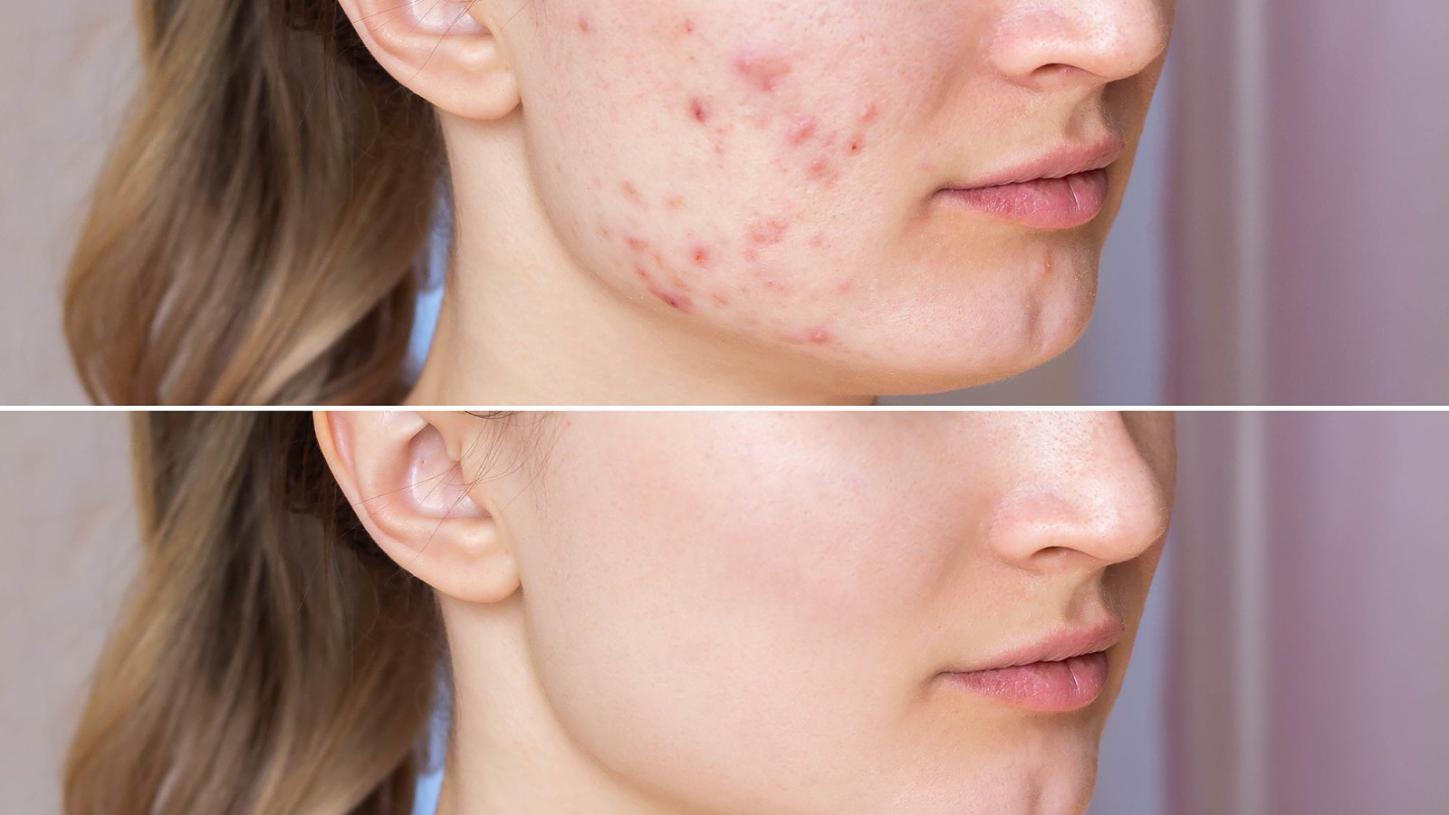acne-patches-hot-spots