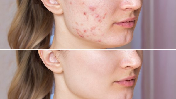 acne-patches-hot-spots