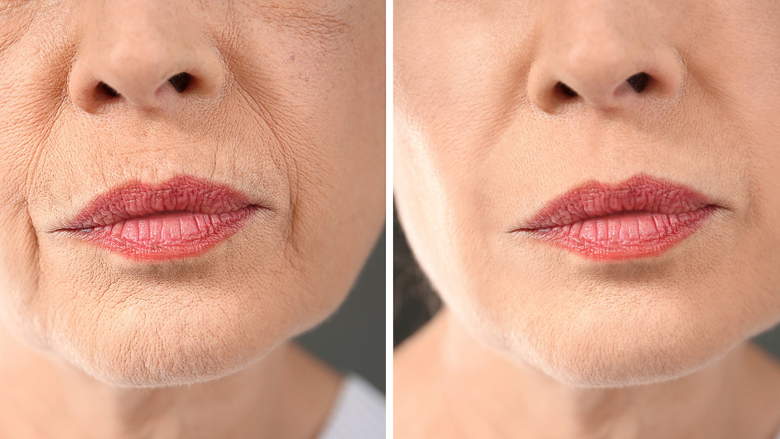 bloommy-retinol-cream-wrinkles-before-after