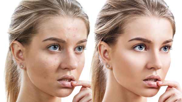m3-facial-serum-before-after