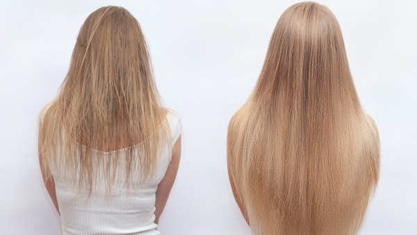 Before-After-Hair-Growth-Stock-Photo