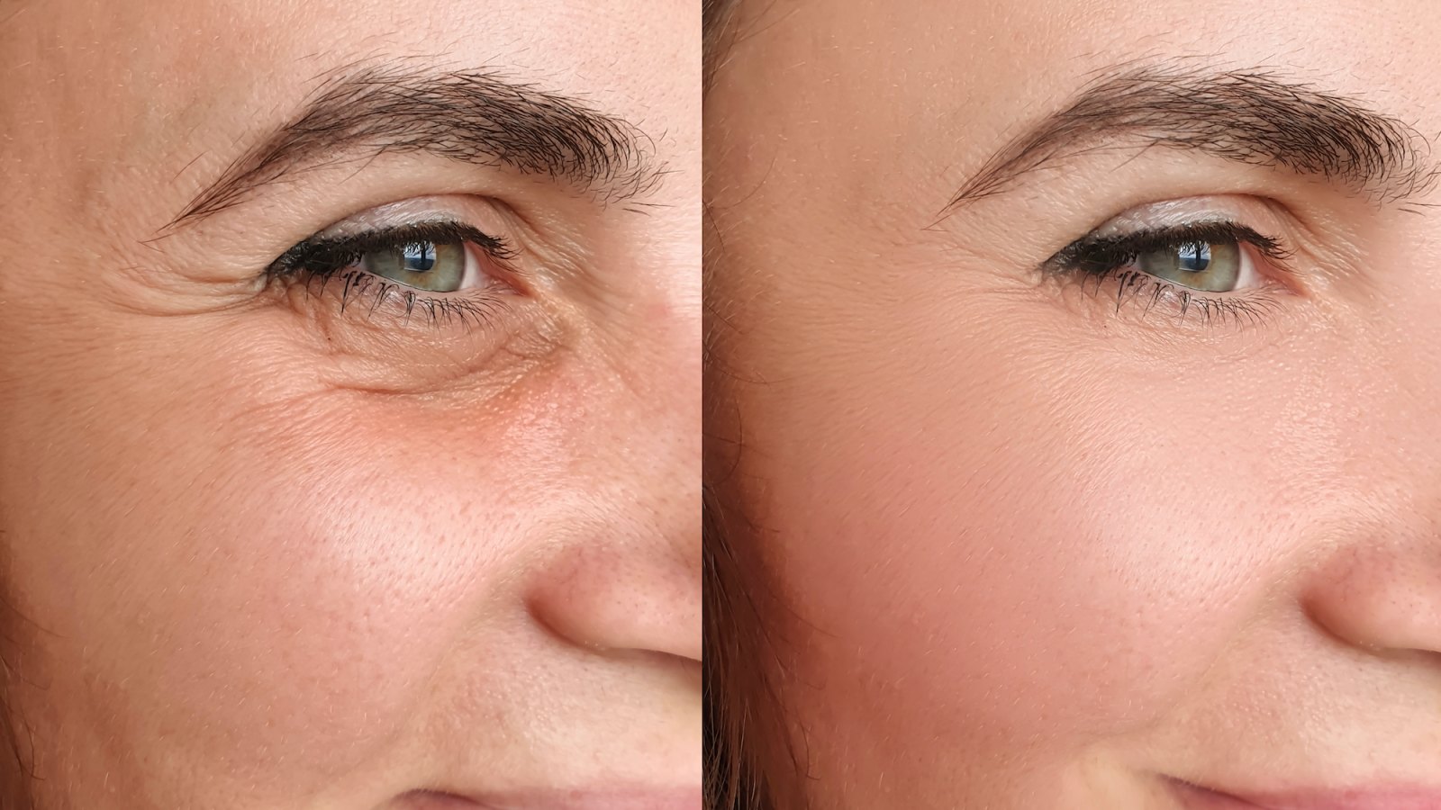 Before-After-Wrinkle-Treatment