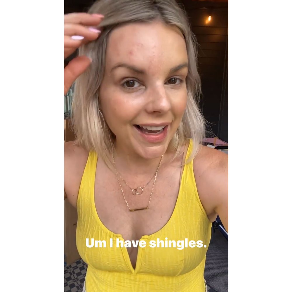 Former Bachelorette Ali Fedotowsky Reveals That She Has Been Diagnosed With Shingles 2