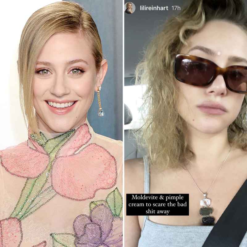 Lili Reinhart Rocking Pimple Cream Is Seriously Relatable Pic