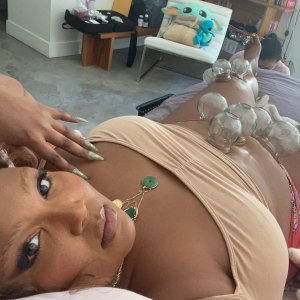 Lizzo Is Doing Cupping Treatment Her Stomach