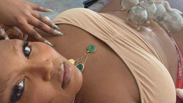 Lizzo Is Doing Cupping Treatment Her Stomach