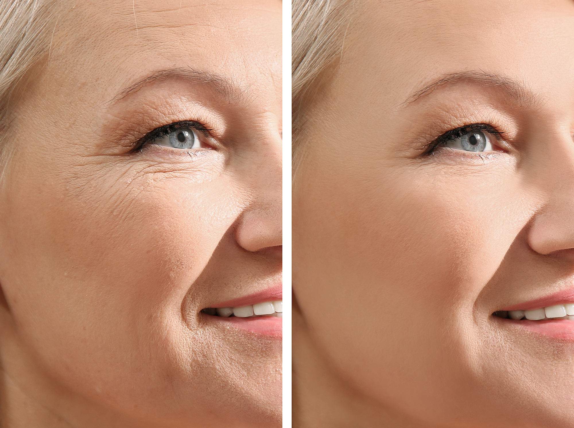 wrinkle-before-after