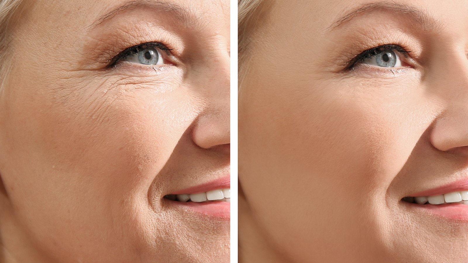wrinkle-before-after