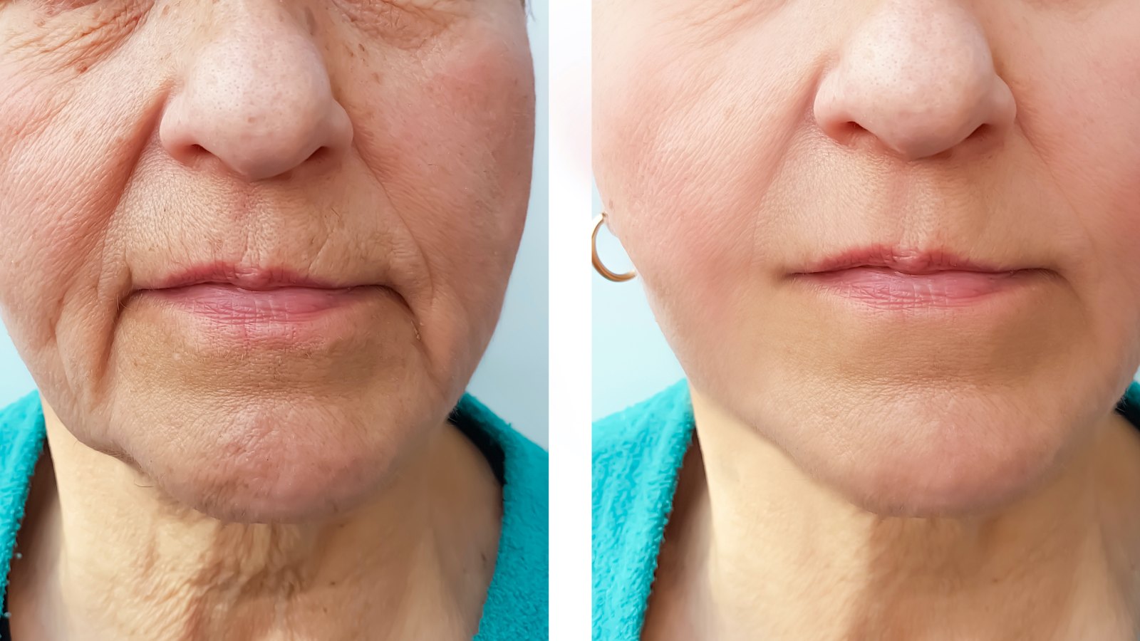 Before-After-Wrinkle-Treatment
