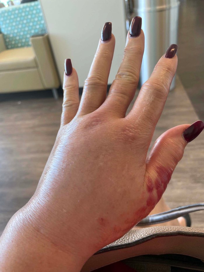Brandi Glanville Hospitalized Hand Infection I Could Lose Limb